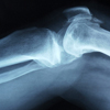 Fájdalmas ízületi betegség: a rheumatoid arthritis