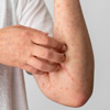 Allergiás bőrbetegség