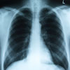 Fájdalomcsillapítás COPD esetén