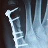 Fájdalmas gyulladást okozhat a fém implantátum