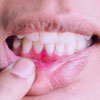A leggyakoribb tévhitek a fogínybetegségről